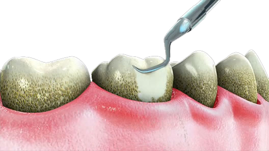 La limpieza dental te ayuda a conservar unos dientes blancos y un aliento fresco