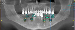 Planificación digital de la colocación de los implantes dentales