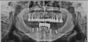 Implantes dentales, radiografía panorámica.