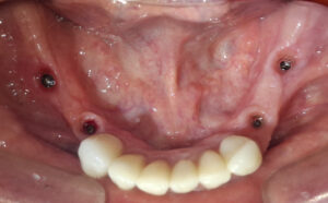 Se observan los implantes dentales en boca.