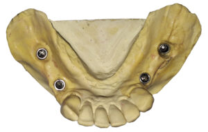 Impresión de implantes dentales.