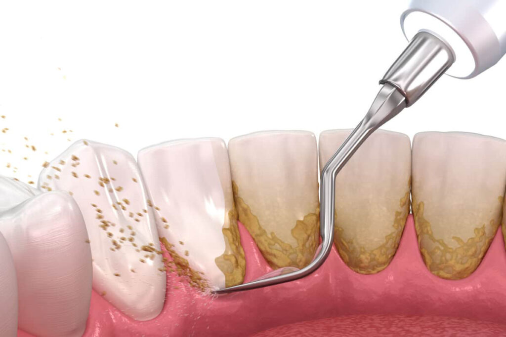 La Limpieza Dental remueve la placa bacteriana que forma las manchas amarillas de los dientes.
