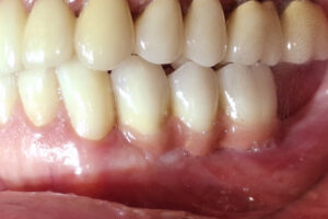 Mordida de la prótesis fija en porcelana sobre implantes dentales.