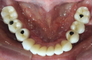 Prótesis fija sobre implantes dentales
