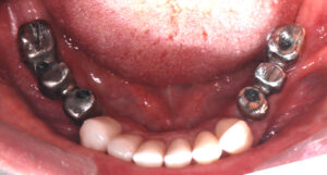 Prueba de estructuras en metal para prótesis fija sobre implantes dentales